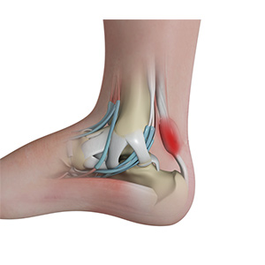 Achilles Tendinitis