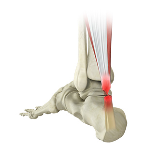 Achilles Tendon Rupture