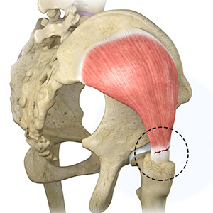 Gluteus Tendon Tear