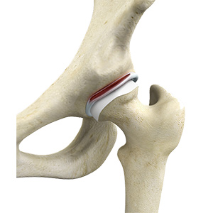 Hip Labral Tear