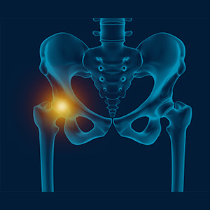 Hip Pain