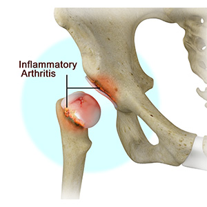 Inflammatory Arthritis of the Hip