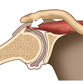 Internal Impingement of the Shoulder