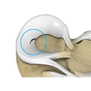 Meniscal Tears