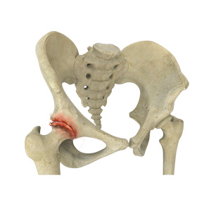 Osteoarthritis of the Hip