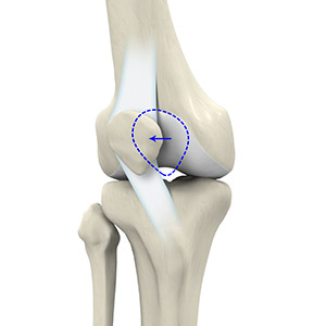 Patellar Dislocation/Patellofemoral Dislocation