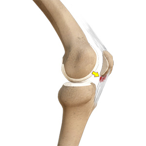 Patellar Tendinitis