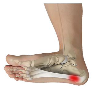 Plantar Fasciitis