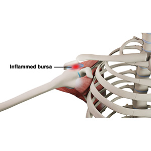 Rotator Cuff Bursitis