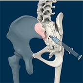 Sacroiliac Joint Injections