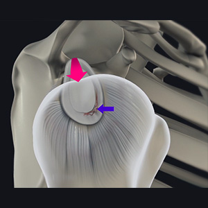 Shoulder Labral Tear with Instability