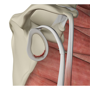 Shoulder Labral Tear