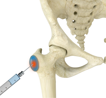 What is hip bursitis? – Midwest Center for Joint Replacement