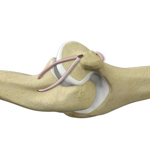 Ulnar Collateral Ligament Injuries