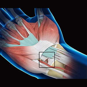 Wrist Ligament Tear and Instability