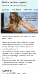Does PRP work for hand pain and wrist pain? Carpal Tunnel? De Quervain