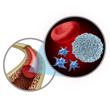 How Bone Marrow Concentrate Can Be Used to Improve Surgical Outcomes