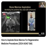 How do you get bone marrow for a regenerative medicine procedure? Answers here!