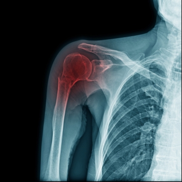 Regenerative Medicine, the Shoulder, and the Rotator Cuff
