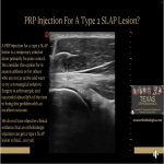 Should we do PRP Injections for SLAP Lesions?  Why?  What is the goal?