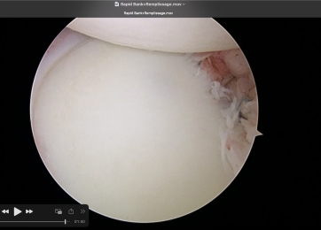 Shoulder dislocation, subluxation, or instability? We can help!