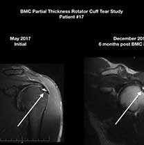 Stem Cells for Partial Thickness Rotator Cuff Tears