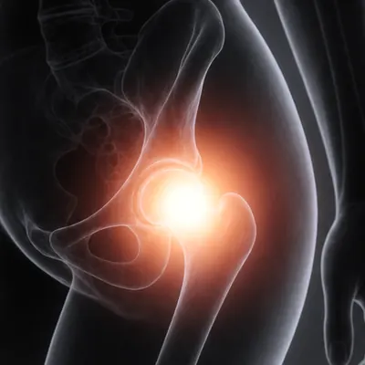 Hip pain — Texas Orthobiologics