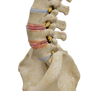 Picture of Degenerative Disc Disease