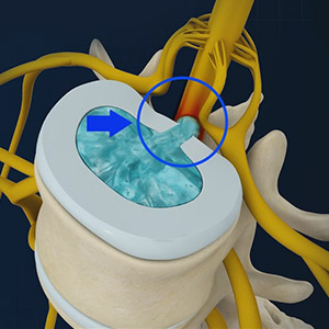 Picture of Disc Herniation