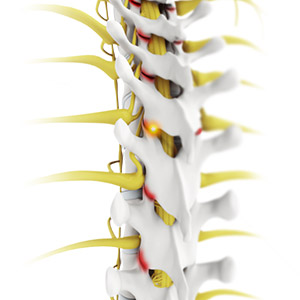 Picture of Facet Joint Arthritis